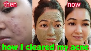 Anti-Acne Face Mask |How I Cured My Hormonal, Cystic Acne | Neem Tulsi Face pack for Acne, Pimples |
