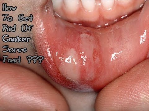 How To Get Rid Of Canker Sores Fast Get Rid Of Canker Sores Party 1 Youtube