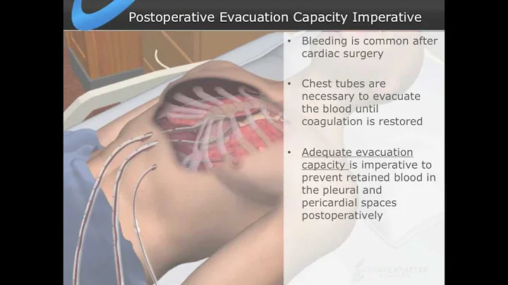 Cardiovascular Surgical Symposium, 2013 - Part 1, Chest Tube Clogging Impairs Evacuation Capacity - DayDayNews