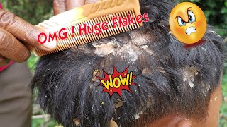 Itchy Dry Scalp and Scratching Treatment - Psoriasis - Dandruff Removal  Huge Flakes, Part 224