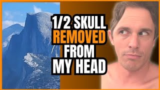 🤯 What is was like Living with Half a Skull. Discover the Jaw-Dropping Journey Beyond Appearance! 🧠