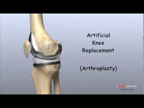 Artificial Knee Replacement 