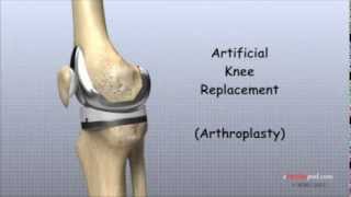 Artificial Knee Replacement