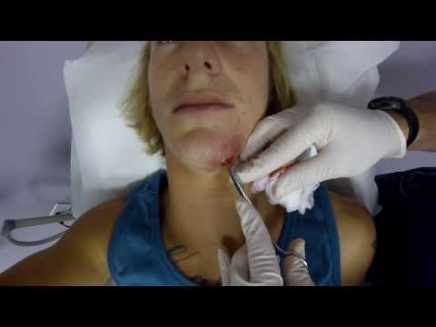 Lance and draining MRSA staph infection on face || VERY GRAPHIC 18+