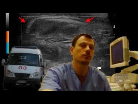 Детское УЗИ мягких тканей - Межмышечное образование подмышечной области у ребенка