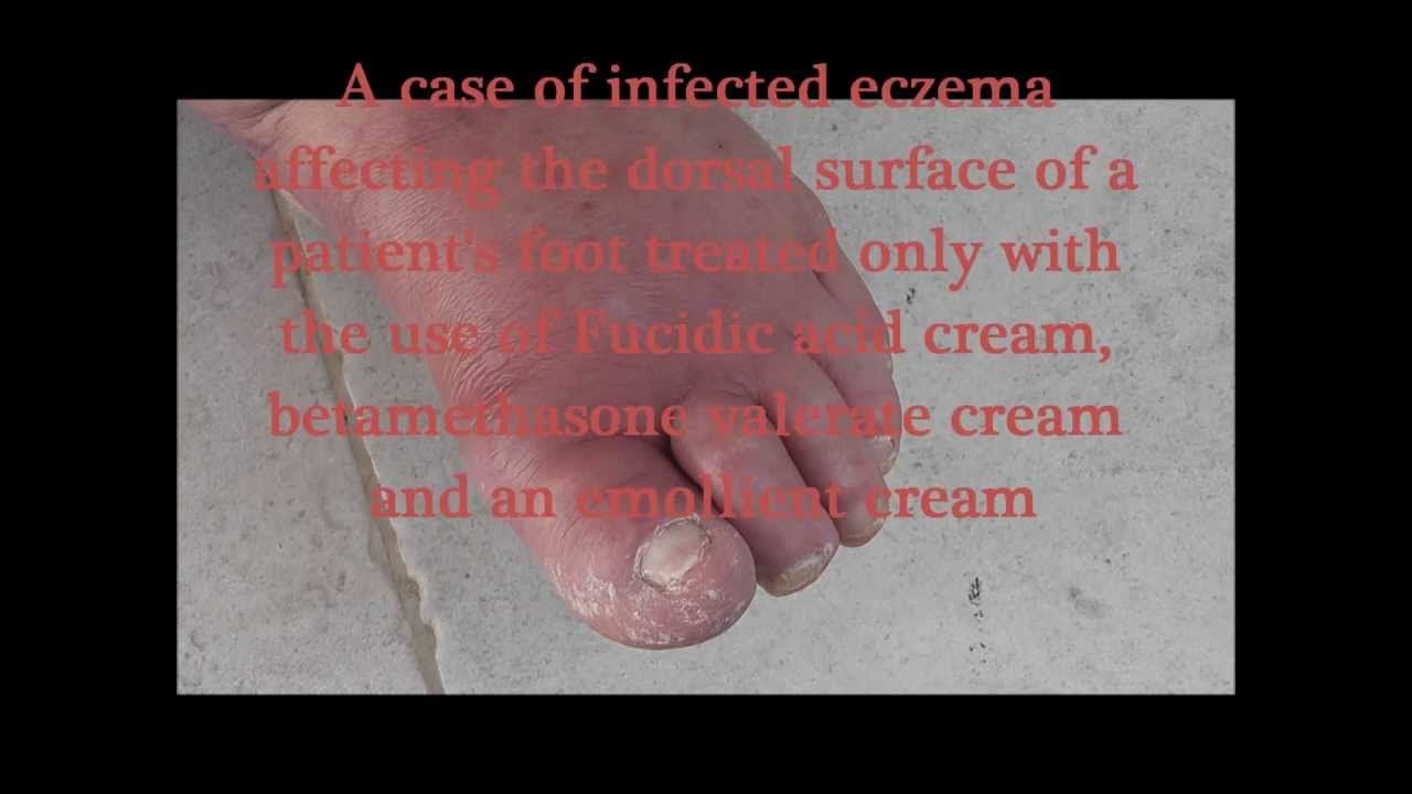 A case of infected foot eczema treated only with creams YouTube