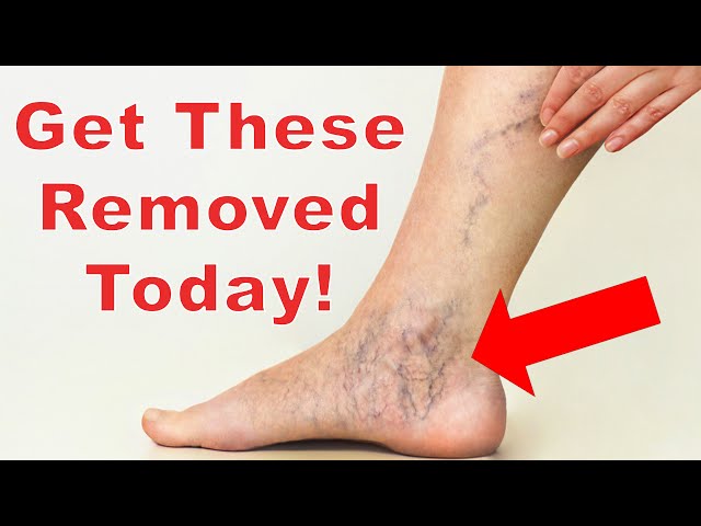 Spider Veins Frightening You?