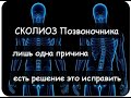 СКОЛИОЗ ЛЕЧЕНИЕ И ПРИЧИНЫ