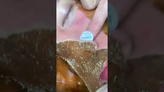 the face remove the pimple skin care #the pimple remover #magical #Relieve stress#Deep cleanse pores