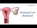 Ovarian cyst removal - Medical Tourism Mexico