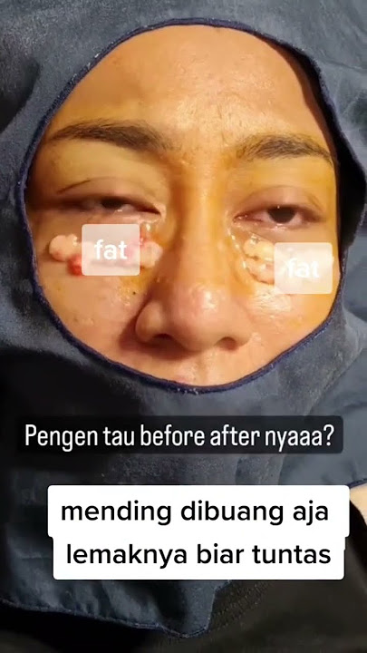 Solusi lemak bawah mata😍