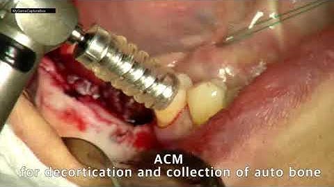 Simple and minimally invasive 3-D ridge augmentation using #santa #vertical_augmentation