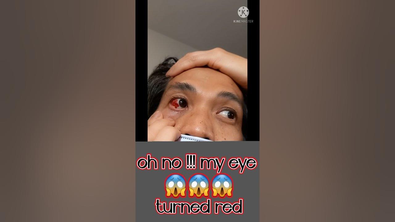 my-eye-turned-red-youtube