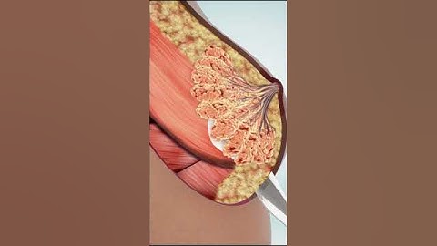 In breast augmentation operation,it is aimed to improve the natural body dimensions of our patients.