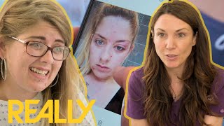 Dr. Emma Finds Out That Patient Was Misdiagnosed And Has A Rare Condition | The Bad Skin Clinic