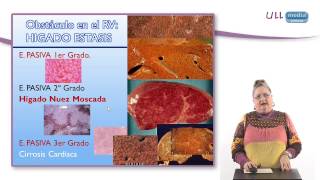 Pulpa hiperemia
