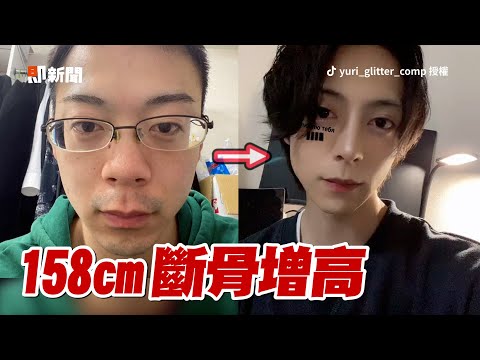 日本158cm男砸千萬斷骨增高！「隆鼻、除斑」變紅牌帥公關｜整形｜重生｜新奇
