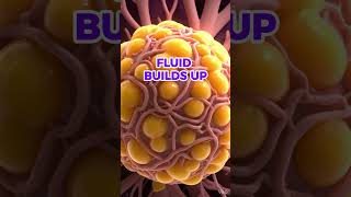 What Happens When Your Lymphatic System Becomes Weak #goldenagehealth #facts #bloodflow