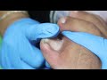 Ep_3277 Ingrown toenail removal 👣 เจ็บ..จนนิ้วสั่น 😷 (clip from Thailand)