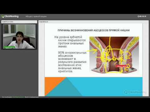 "Современное лечение абсцесса прямой кишки и заднего прохода", вебинар 10.11.2015
