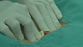 Hemostasis method using Anscare ChitoClot Pad on Femoral access