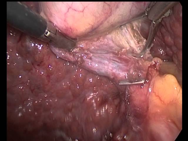 Laparoscopic Cholecystectomy in Cirrhotic Patients sirrozlu xəstədə öd kisənin çıxarılması