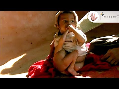 Video: A Baby Was Born In Africa With Four Legs - Alternative View