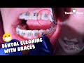 Dental Cleaning with Braces - Braces checkup and Cleaning appointment same day - Tooth Time