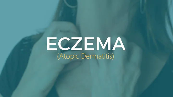 What to do if you have eczema (atopic dermatitis)