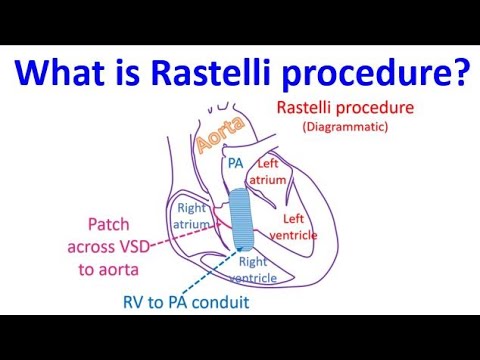 Rochelle Rastelli What is Rastelli procedure? - YouTube