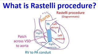 What is Rastelli procedure Noticias