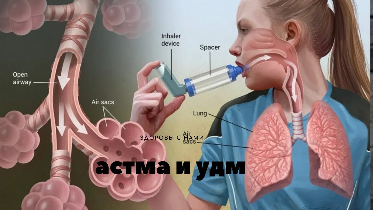 Астма много лет. Как отказаться от ингалятора?