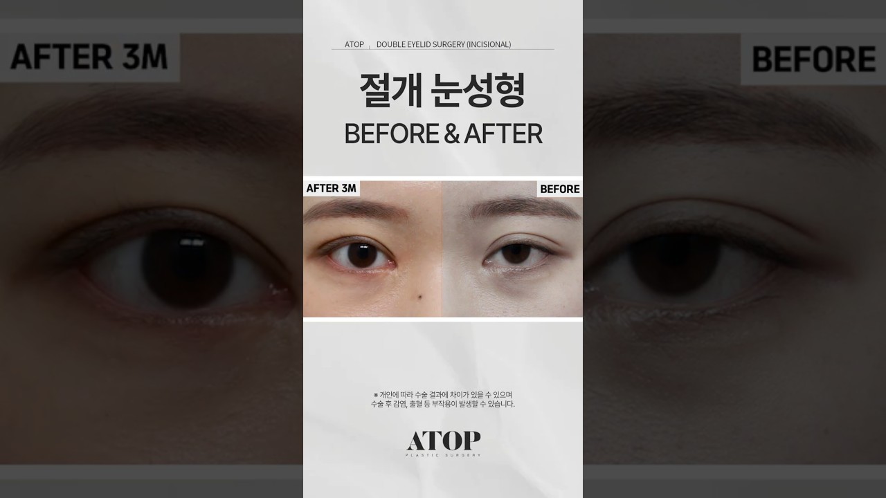 [艾塔普整形外科] 女性切開式雙眼皮手術_術後分享5