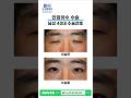 남성 40대 안검하수 수술전후 비아이오성형외과 홍성표원장 #안검하수