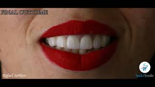 Feldsphatic Veneers &amp; Zirconia Crowns