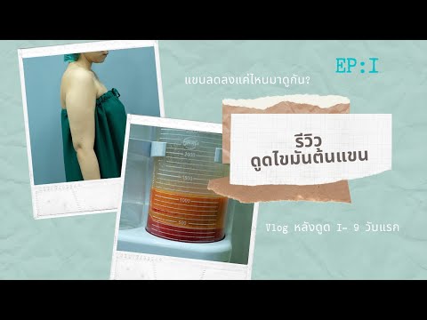 รีวิวดูดไขมันต้นแขน Issavee Clinic แขนเล็กลงจริงหรือป่าว? มาดูกัน