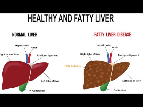 Do You Have a Fatty Liver Here Are the Causes and How to Cleanse It!