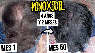 50 Meses Usando MINOXIDIL en el CABELLO RESULTADOS 4 Años y 2 Meses Tratamiento Alopecia Hombre