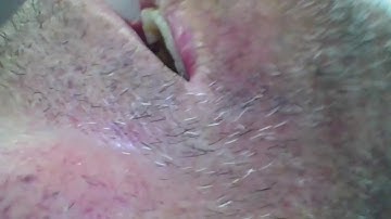 Videolaryngoscopy in the management of the difficult airway 1