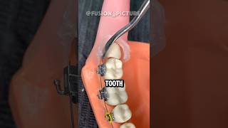 How Dentists Remove A Tooth