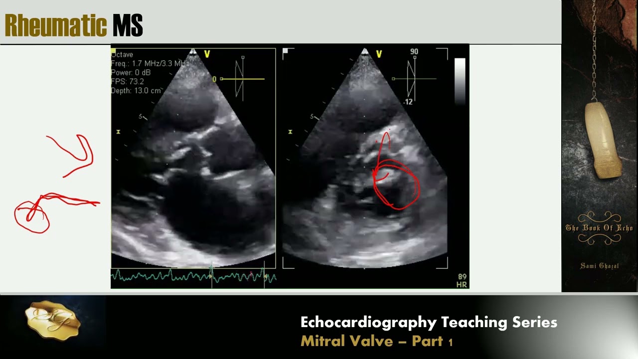 Lecture 11 - Mitral Valve Part 1