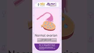 Have You Been Advised Surgery For Ovarian Cyst Removal?