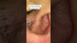 Ear blackhead extracted  #blackheadremoval #acneremoval #pimples