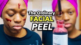 The Ordinary Skincare Review |  AHA 30% + BHA 2% Peeling Solution | Exfoliating Skin | Deciem