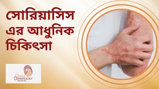 সোরিয়াসিস (Psoriasis) এর আধুনিক চিকিৎসা