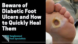 Beware of Diabetic Foot Ulcers and How to Quickly Heal Them screenshot 4