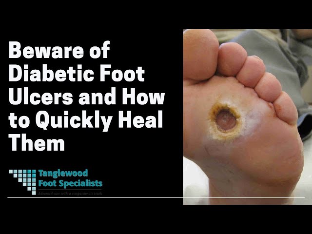 Diabetic foot | Diabetes Québec