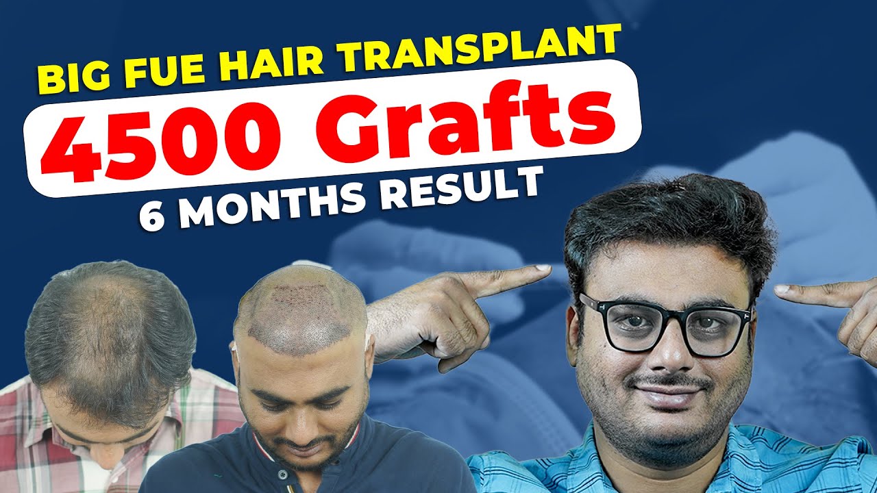 Best Hair Transplant in Pune BigFUE Grade5 4640 Grafts