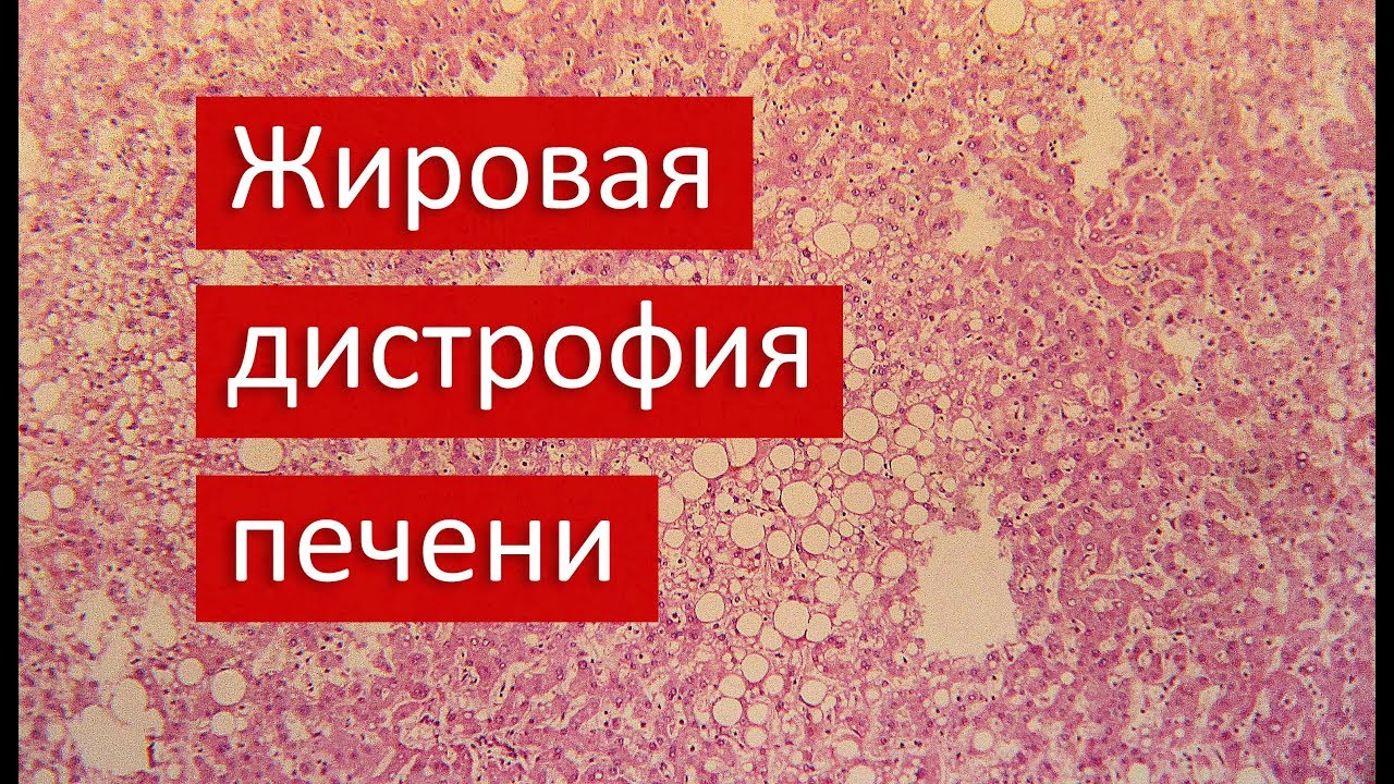 Жировая дистрофия печени | Патанатомия - YouTube