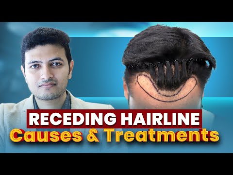 Receding Hairline? 😲 Don't Panic! Explore Causes & Discover Treatment Options | New Roots